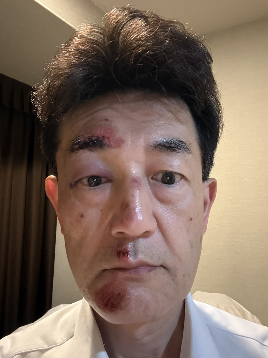 転倒後の怪我の写真